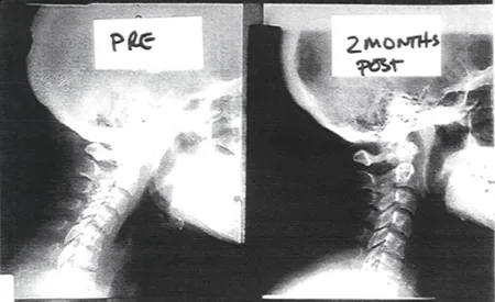 Side-by-side X-ray comparison of cervical spine labeled PRE and 2 MONTHS POST showing vertebral alignment changes