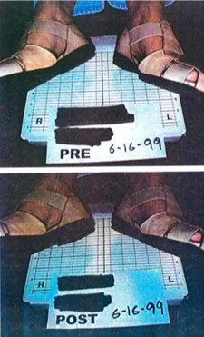 Before and after foot positioning on a blue measurement scale showing alignment correction