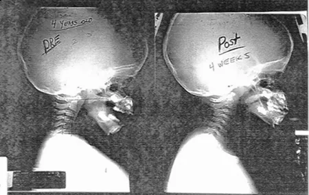 Black and white X-ray comparison images labeled Pre and Post showing before and after views, 4 weeks apart