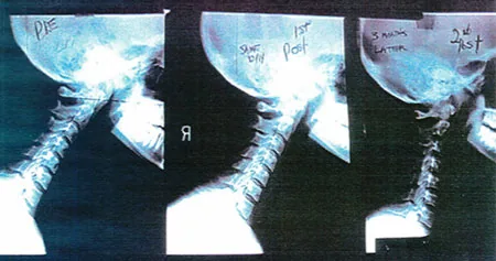 Three cervical spine X-rays showing different angles of the neck with annotations