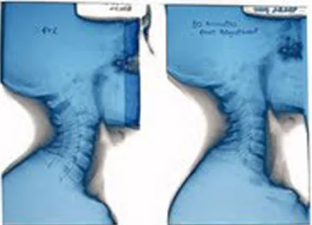 Side-by-side anatomical illustrations showing neck and shoulder alignment comparison in blue