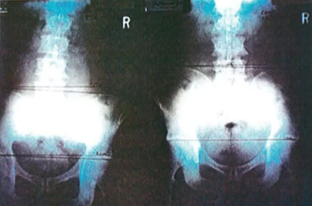 Posterior view X-ray of pelvis and lower spine showing symmetrical bone structure