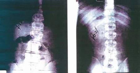 Spinal X-rays showing frontal and lateral views of the spine with measurement markers