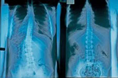 Frontal and lateral chest X-rays showing lungs, ribcage, and spine