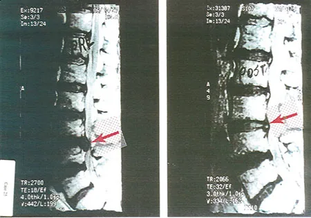 Two side-by-side X-ray images of the spine with technical measurements and a red arrow indicator
