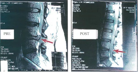 Before and after spinal X-ray images showing vertebral alignment comparison