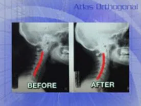 Side-by-side X-ray comparison showing cervical spine alignment before and after chiropractic treatment