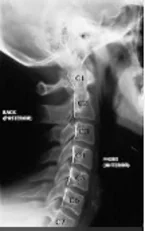 X-ray of cervical spine showing normal curved alignment