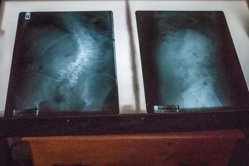 Two spinal X-rays displayed on illuminated viewer showing vertebral column from different angles