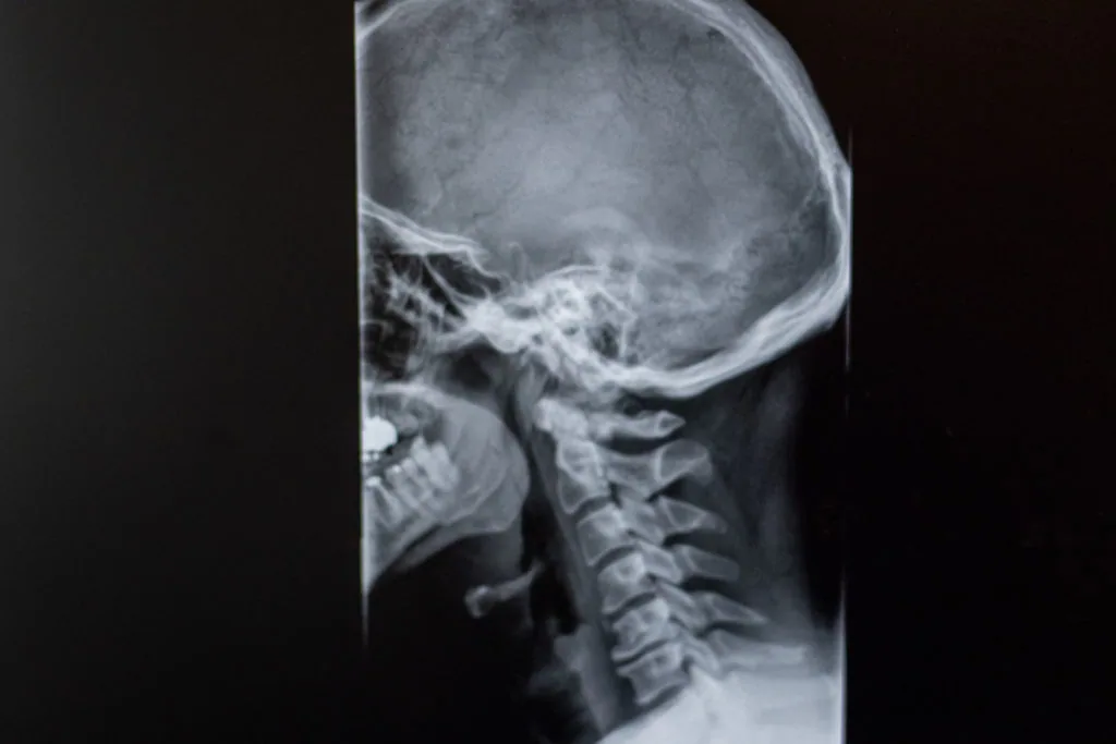 Lateral skull and cervical spine X-ray showing skull, jaw, and neck vertebrae in profile view.